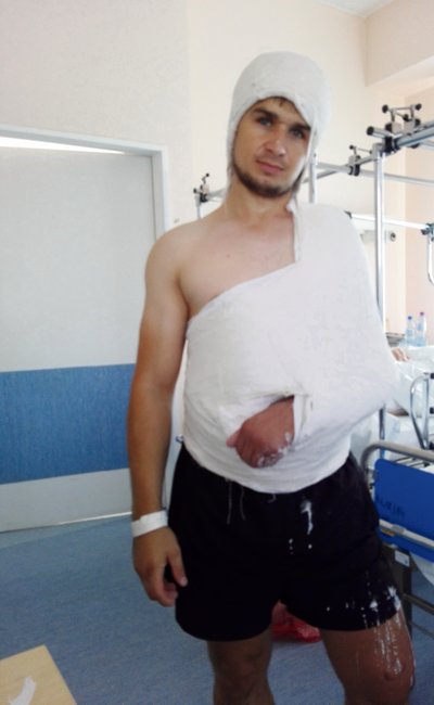 Mateusz po operacji splotu ramiennego z przeszczepem nerwu łydkowego (5 miesięcy po wypadku). Tak wyglądały szwy na jednej z operowanych nóg